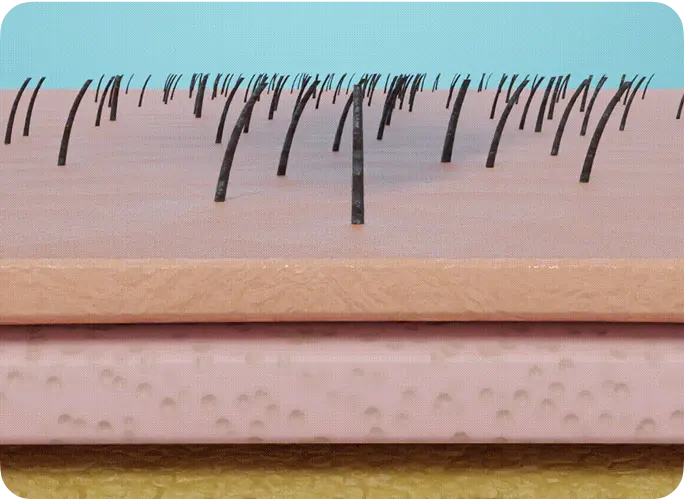 Hair transplant for Leeds patients. FUE procedure coordinated by Vertex Medic