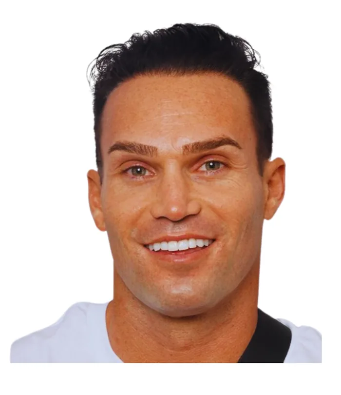 FUE hair transplant 12 months after, case 001