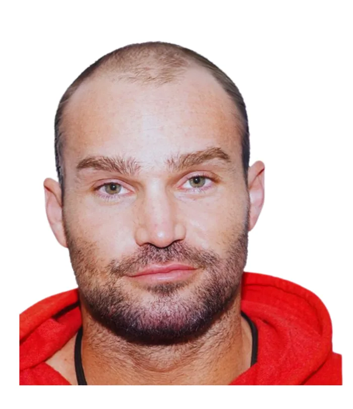 FUE hair transplant before, case 001