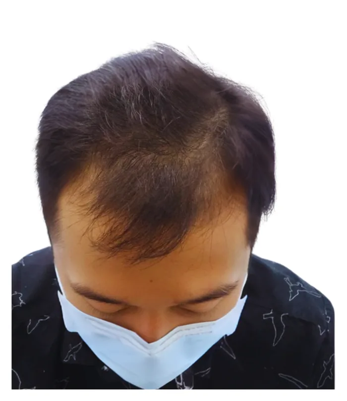FUE hair transplant before, case 002
