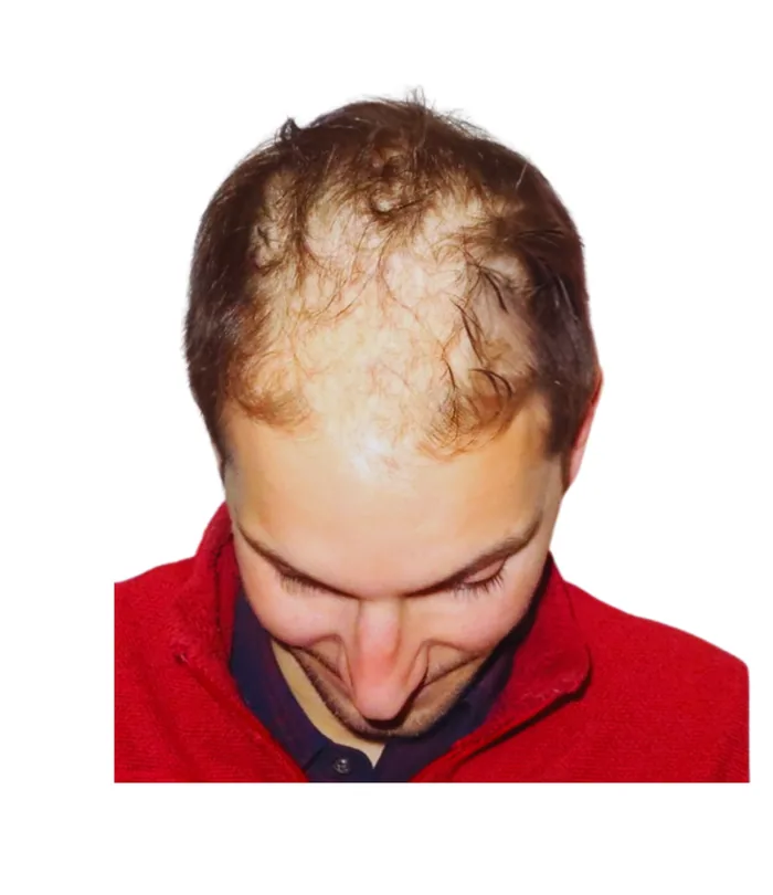 FUE hair transplant before, case 003