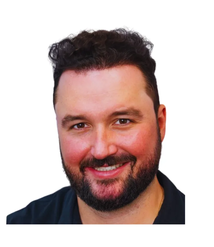 FUE hair transplant 12 months after, case 004