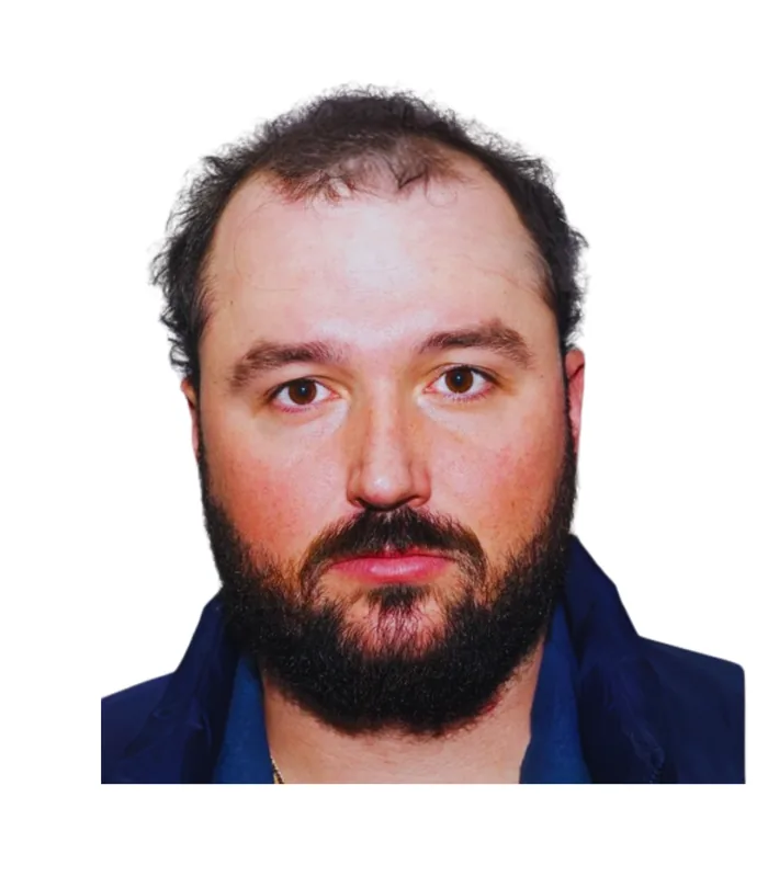 FUE hair transplant before, case 004
