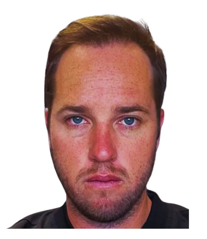 FUE hair transplant 12 months after, case 005