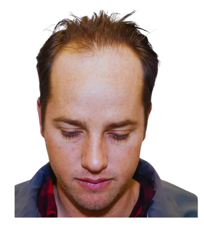 FUE hair transplant before, case 005