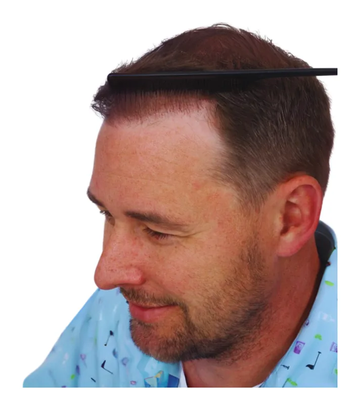 FUE hair transplant 12 months after, case 006