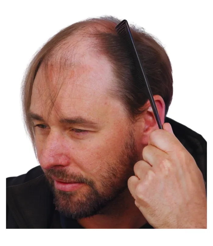 FUE hair transplant before, case 006