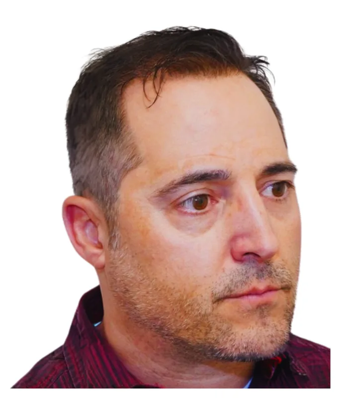 FUE hair transplant 12 months after, case 007