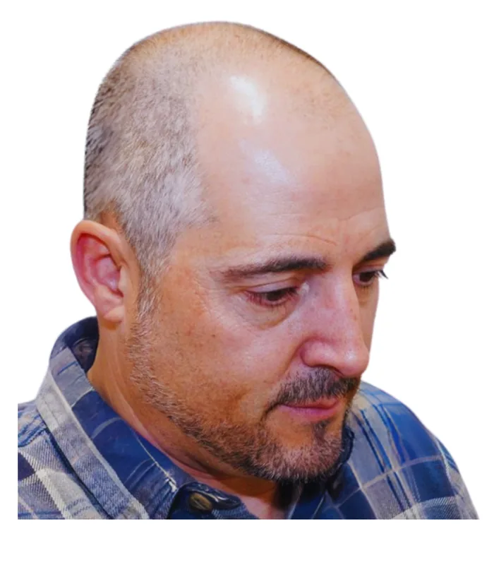FUE hair transplant before, case 007
