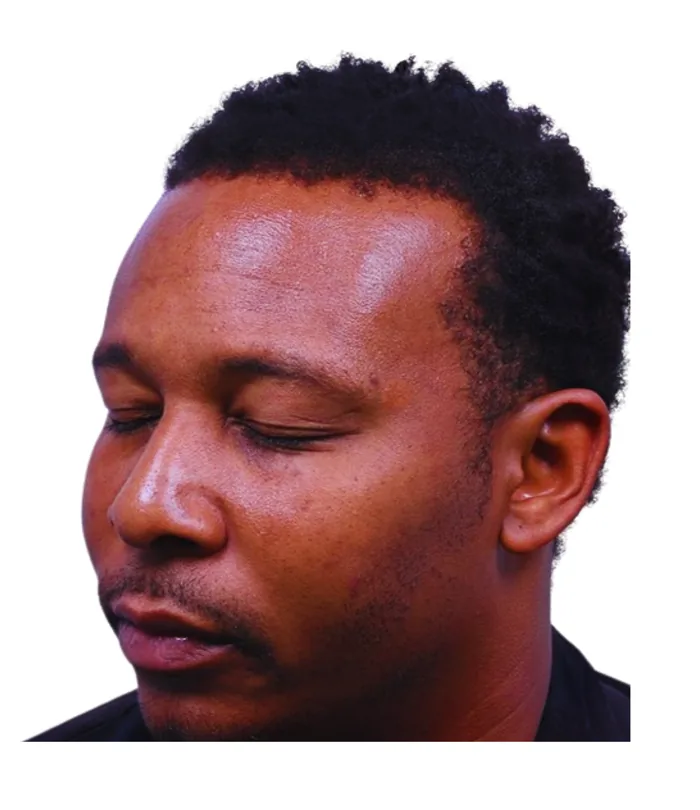 FUE hair transplant 12 months after, case 008