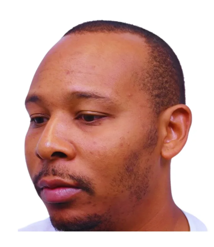 FUE hair transplant before, case 008
