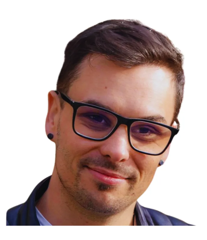 FUE hair transplant 12 months after, case 009
