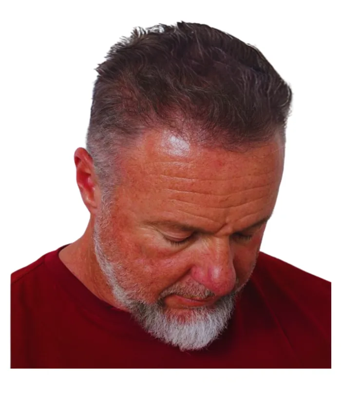 FUE hair transplant 12 months after, case 010