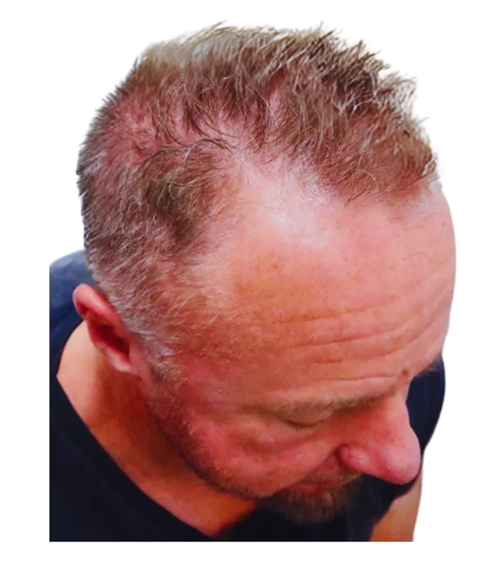 FUE hair transplant before, case 010