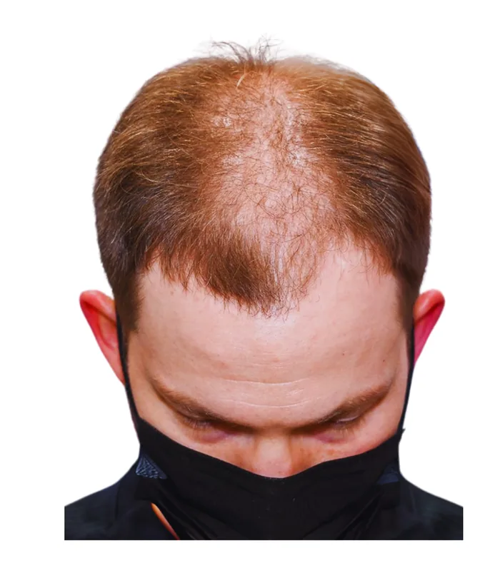 FUE hair transplant before, case 011