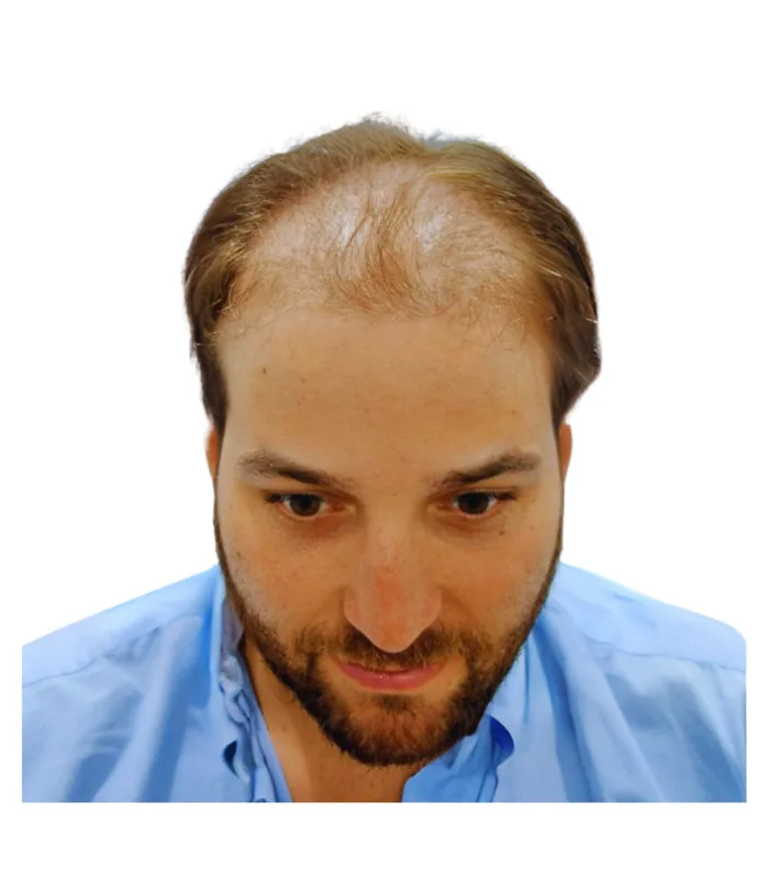 FUE hair transplant before, case 012