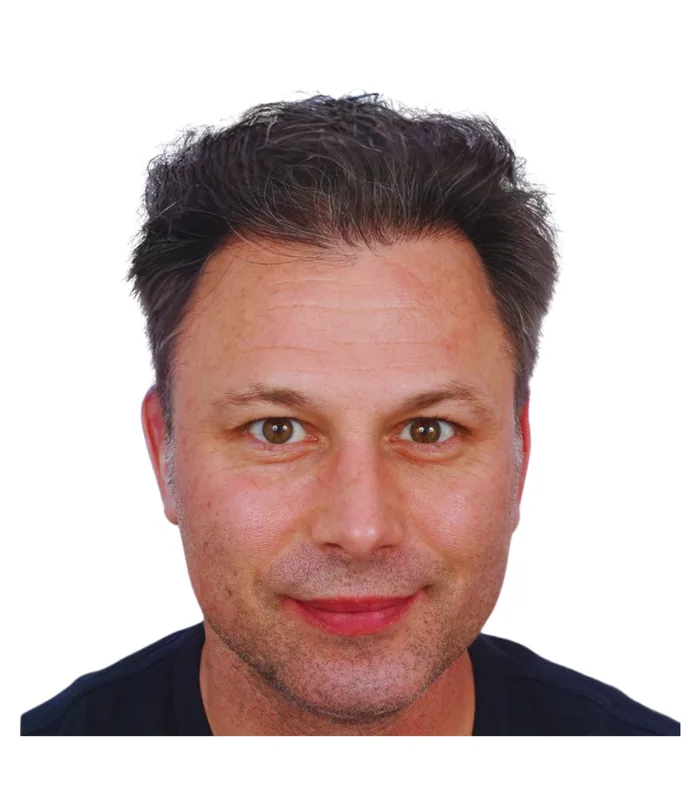 FUE hair transplant 12 months after, case 013