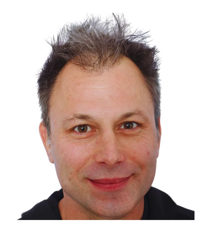 FUE hair transplant before, case 013