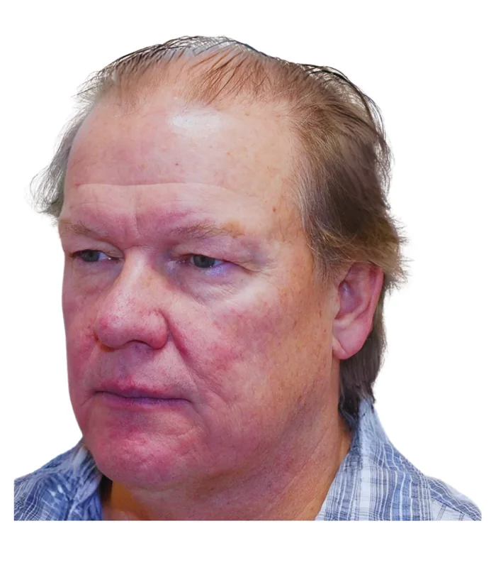 FUE hair transplant before, case 014