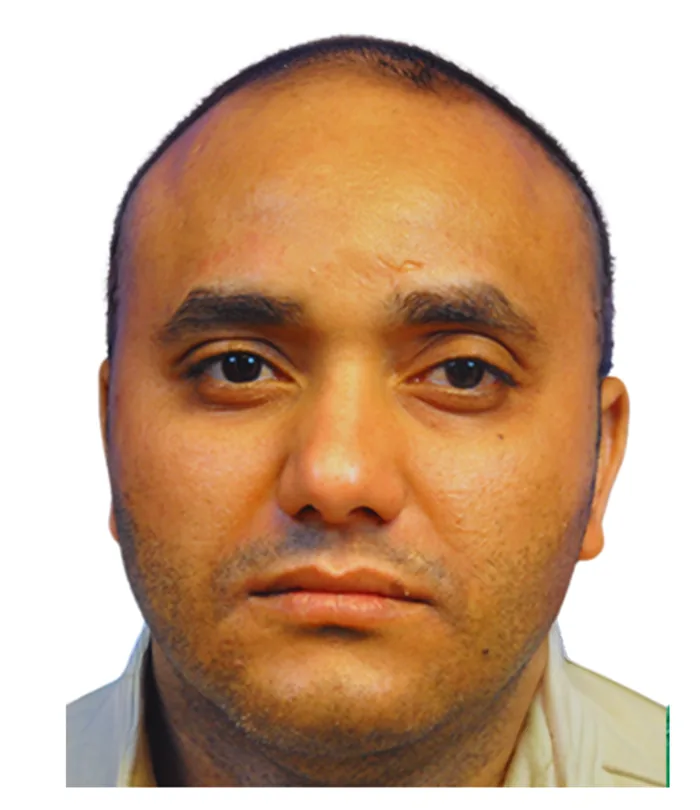 Patient before treatment, hairline receding at the temples
