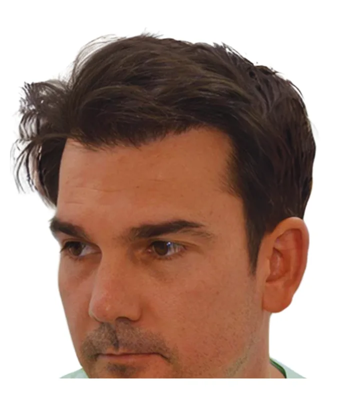 FUE hair transplant 12 months after, case 018