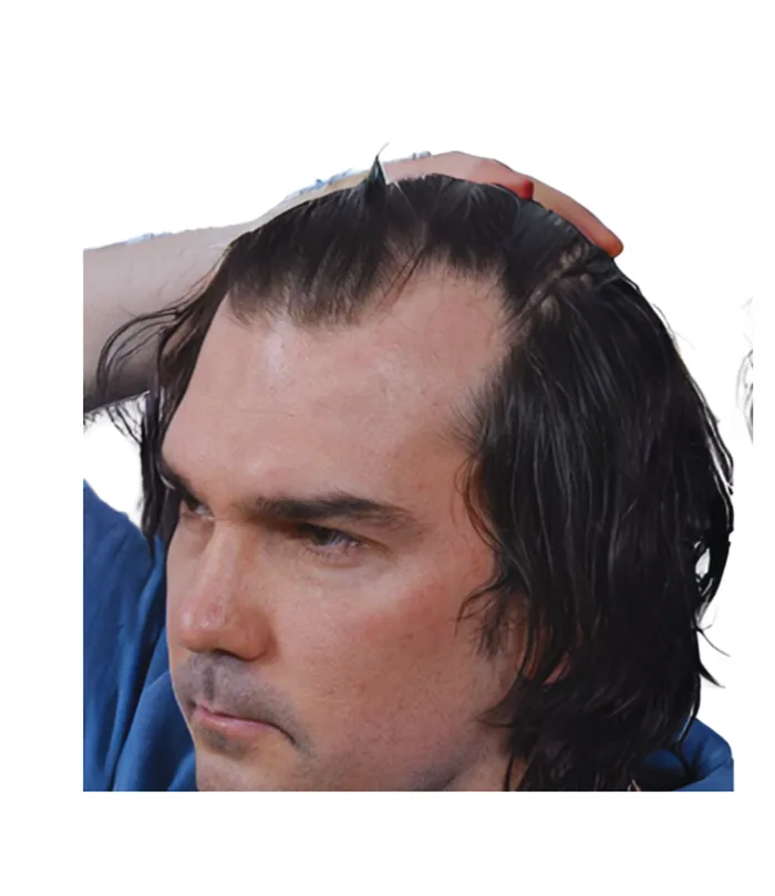 FUE hair transplant before, case 018