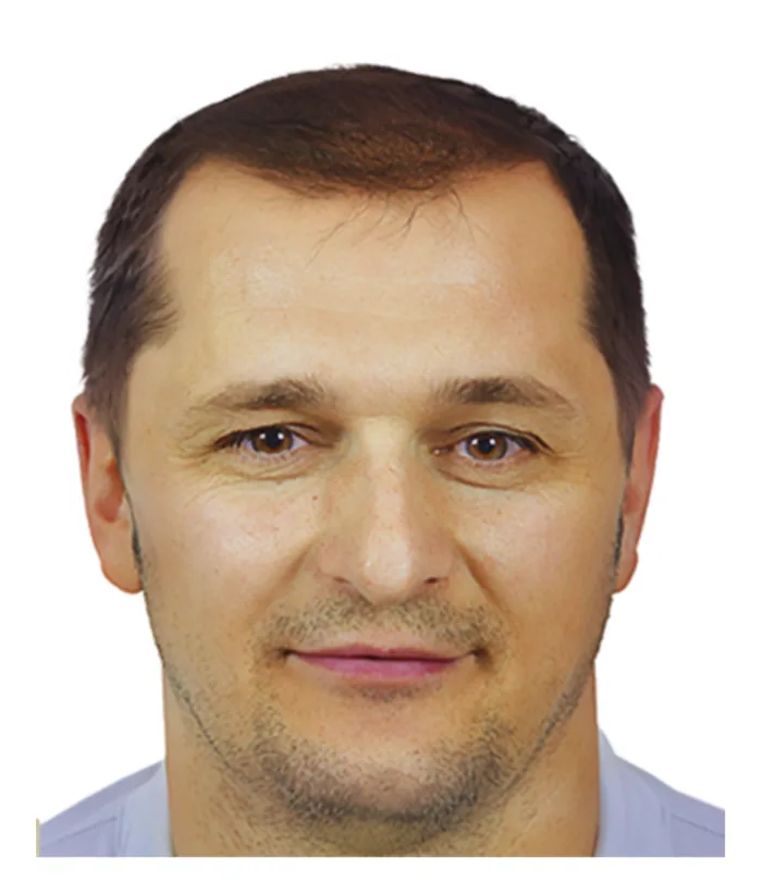 FUE hair transplant 12 months after, case 020