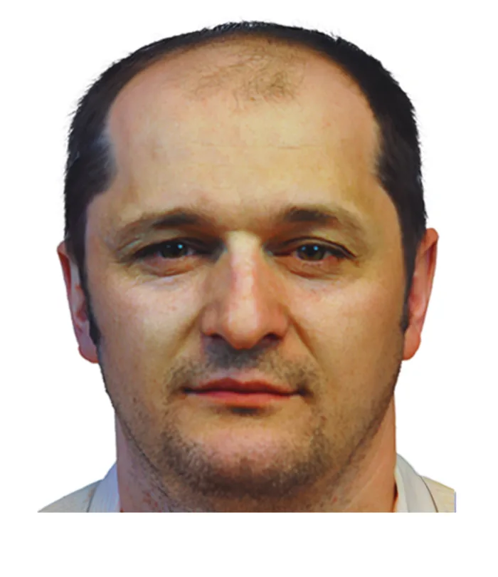 FUE hair transplant before, case 020