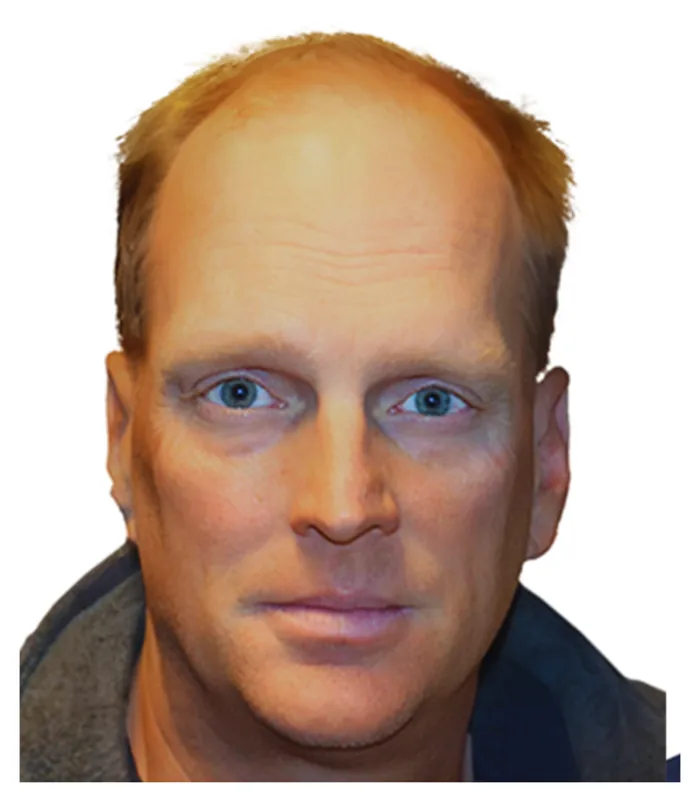 FUE hair transplant before, case 021