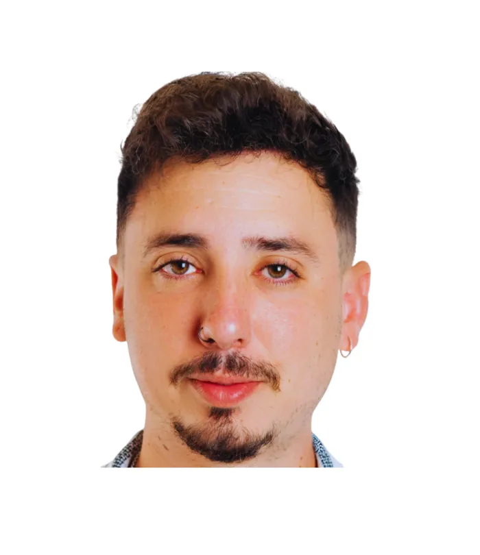 FUE hair transplant 12 months after, case 022