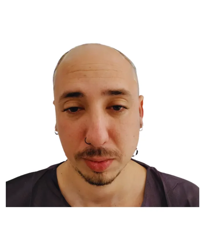 FUE hair transplant before, case 022