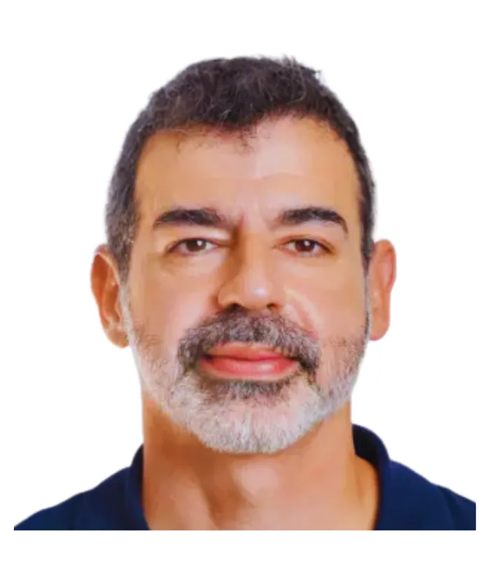 FUE hair transplant 12 months after, case 023