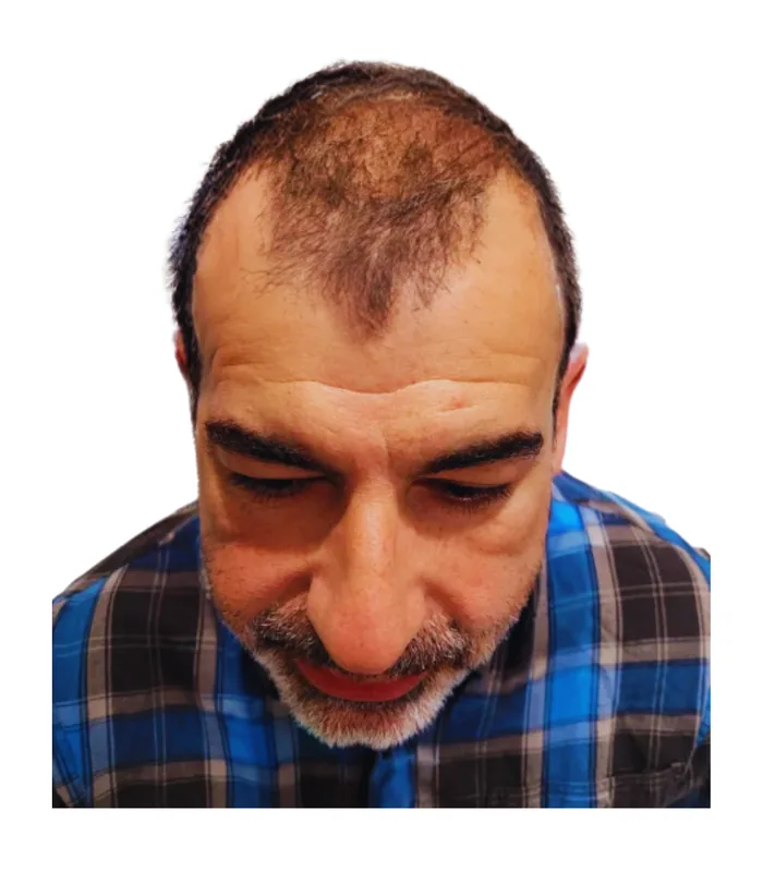 FUE hair transplant before, case 023