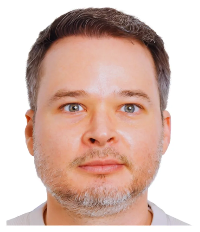FUE hair transplant 12 months after, case 024