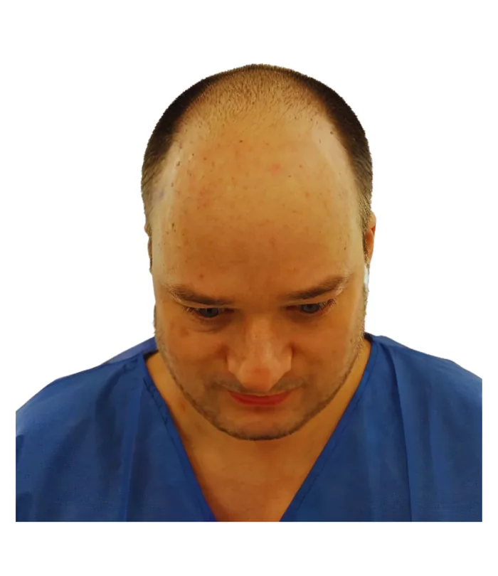 FUE hair transplant before, case 024