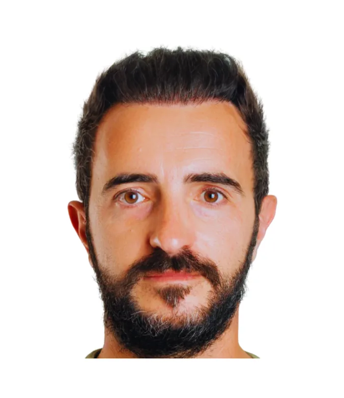 FUE hair transplant 12 months after, case 025