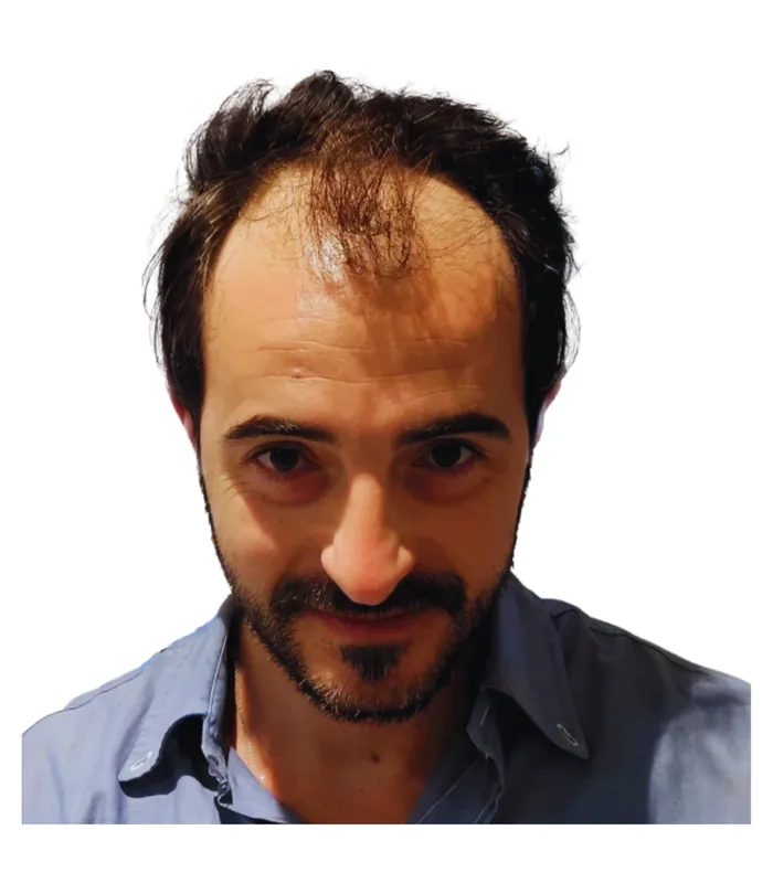 FUE hair transplant before, case 025