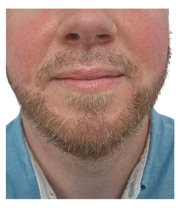 Beard transplant 12 months after, case 026