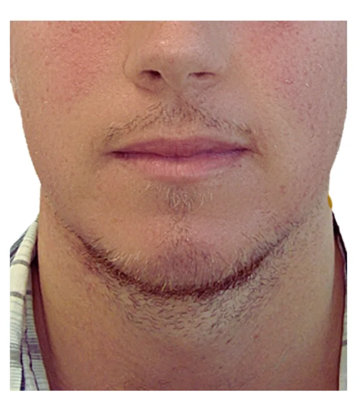 Beard transplant before, case 026