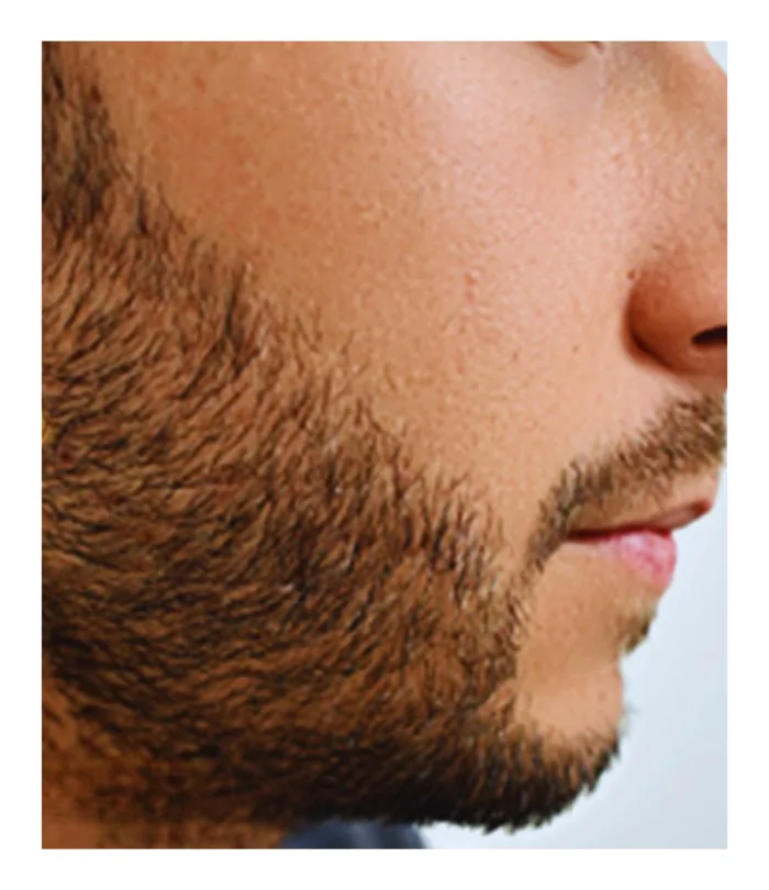 Beard transplant 12 months after, case 027