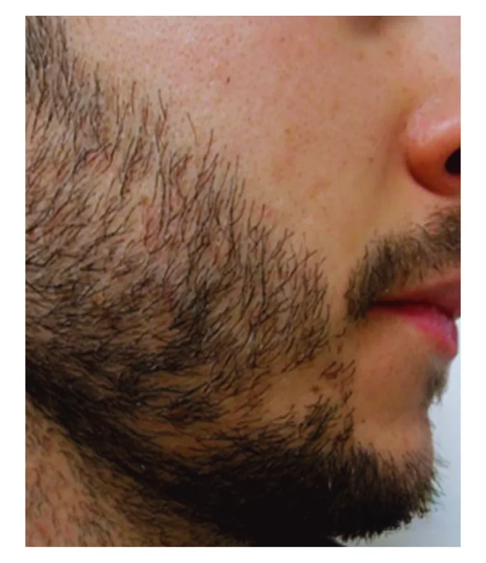 Beard transplant before, case 027