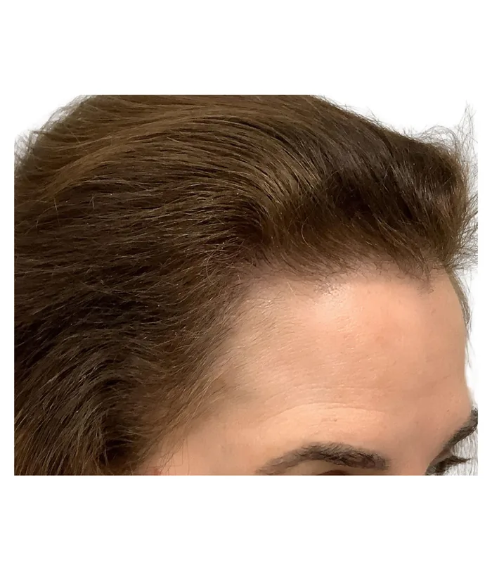 FUE hair transplant 12 months after, case 028
