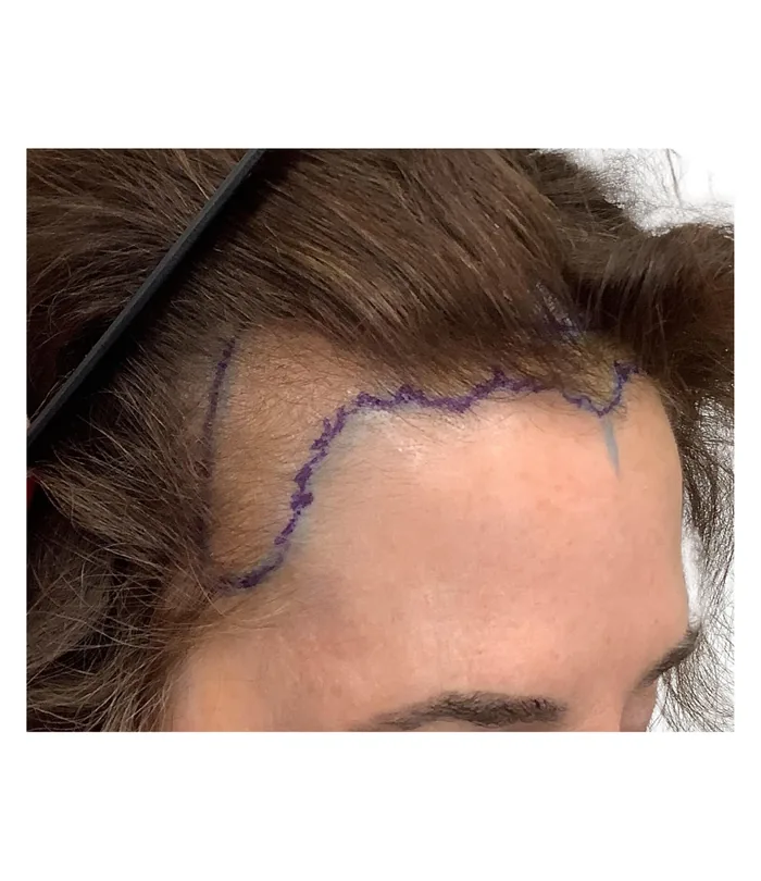 FUE hair transplant before, case 028