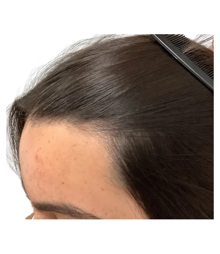 FUE hair transplant 12 months after, case 029