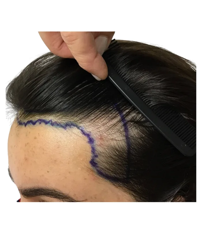 FUE hair transplant before, case 029