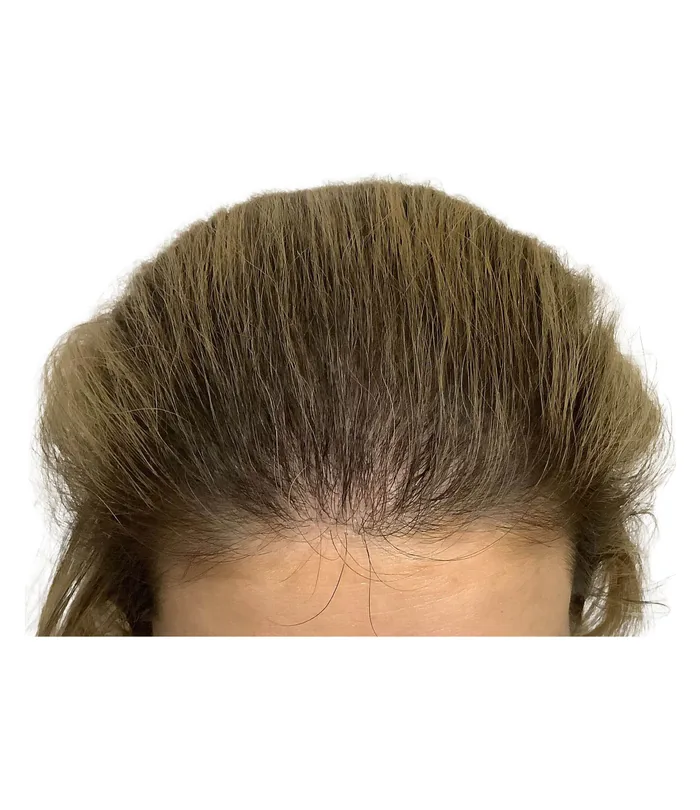 FUE hair transplant 12 months after, case 030