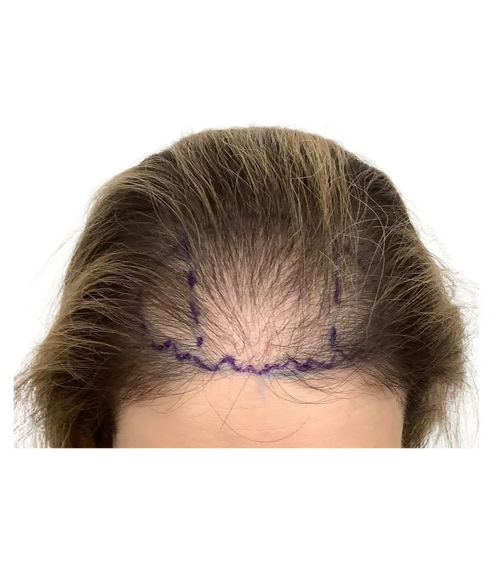 FUE hair transplant before, case 030