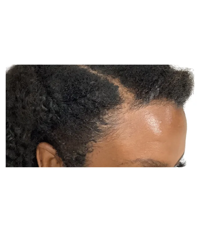 FUE hair transplant 12 months after, case 031