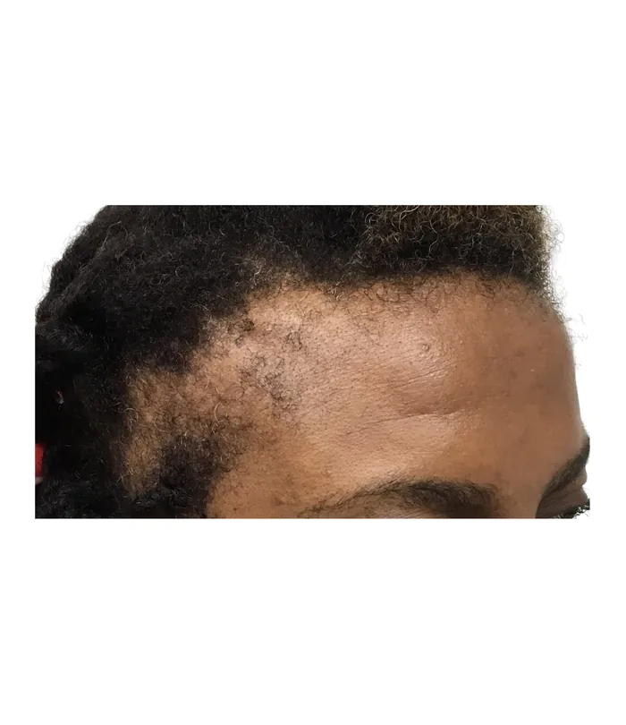 FUE hair transplant before, case 031
