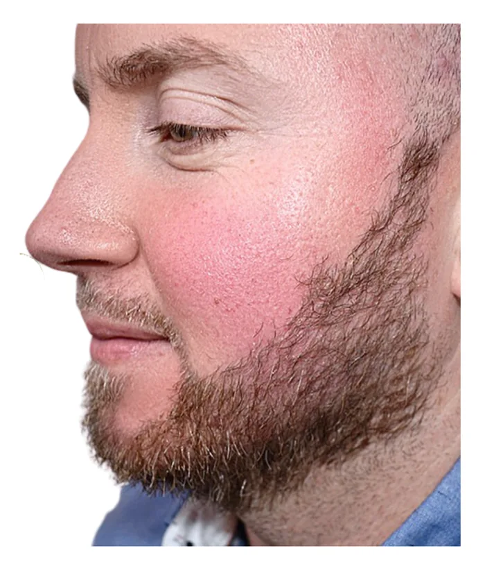 Beard transplant 12 months after, case 032